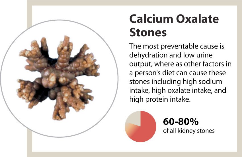 Too Much Calcium Cause Kidney Stones