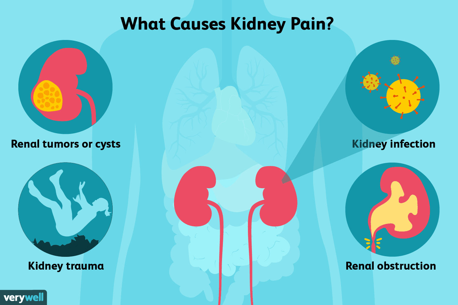 what-causes-throbbing-pain-in-kidney-area-healthykidneyclub