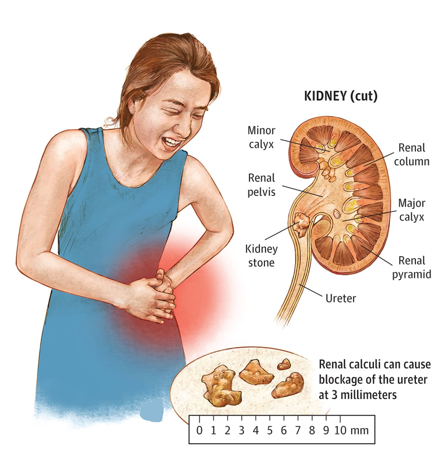 What To Do For Kidney Stones HealthyKidneyClub